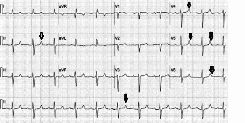 This diagnostic image is a standard 12-lead electrocardiogram (ECG) displayed on a traditional grid background. The tracing demonstrates a sinus rhythm with a key finding of tall, peaked T-waves, highlighted by black downward-pointing arrows in several leads. These hyperacute T-waves are most prominent in the precordial leads V3, V4, and V5, as well as limb lead II, exhibiting high amplitude and a symmetrical, narrow-based morphology (tent-shaped). The QRS complexes appear relatively narrow without significant widening, and the P-waves are visible, suggesting normal atrial depolarization. The ST-segments remain largely isoelectric. This visual presentation is a classic educational example of early ECG manifestations associated with hyperkalemia, which can progress to more severe conduction abnormalities. The image is highly relevant for medical students and clinicians in cardiology, nephrology, and emergency medicine for recognizing electrolyte-induced cardiac electrical disturbances.