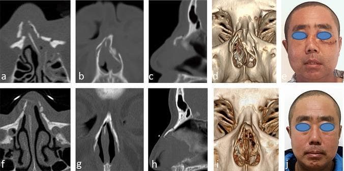 A multi-panel medical comparison set illustrating a nasal fracture case before and after surgical intervention. The top row (a-e) displays preoperative diagnostic and clinical views: (a) axial, (b) coronal, and (c) sagittal CT scans showing comminuted nasal bone fractures with lateral displacement and septal deviation; (d) a 3D CT reconstruction highlighting the skeletal deformity; and (e) a clinical photograph showing visible nasal bridge depression and deviation. The bottom row (f-j) presents postoperative outcomes: (f-h) corresponding CT planes demonstrating anatomical realignment and stable fracture reduction; (i) a 3D reconstruction showing restored nasal pyramid symmetry; and (j) a clinical photograph at 6-month follow-up showing a well-corrected nasal bridge with improved aesthetic contour. The images collectively demonstrate the efficacy of endonasal incision internal reduction (EIIR) for complex nasal fractures involving the nasal bones and frontal process of the maxilla. This content is relevant for otolaryngology and maxillofacial surgery training.