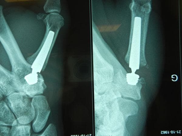 This diagnostic radiograph displays two views of a Moovis carpometacarpal (CMC) joint prosthesis implanted in the thumb. The image illustrates a total joint arthroplasty for the treatment of rhizarthrosis (basal thumb arthritis). The prosthetic system consists of two highly radio-opaque components: a threaded metal cup and a medullary stem. The threaded cup is securely fixed into the trapezium bone, while the elongated, tapered stem is inserted into the proximal medullary canal of the first metacarpal. A ball-and-socket articulation is visible between the stem neck and the trapezial cup, mimicking the natural saddle joint anatomy to restore range of motion and stability. The surrounding cortical bone shows clear contrast against the metallic hardware, and the placement indicates proper alignment within the thumb's CMC joint space. This imaging is characteristic of post-operative orthopaedic assessment to verify component positioning and osseointegration.
