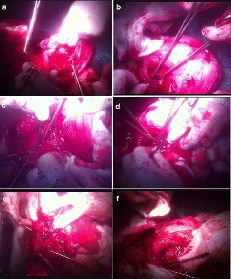 This composite of six intraoperative clinical photographs (a-f) illustrates the surgical steps of the cervical inversion technique used to manage massive hemorrhage from the placental bed. (a) Initial view of the surgical field showing active bleeding from the placental implantation site. (b) Traction and inversion of the cervical lips using two Allis forceps. (c) Insertion of a Hegar dilator into the cervical canal to maintain patency during reconstruction. (d) Suturing of the posterior cervical lip to the posterior wall of the lower uterine segment. (e) Suturing of the anterior cervical lip to the corresponding anterior wall of the lower uterine segment, effectively creating a surgical tamponade. (f) Final stage showing the removal of the Hegar dilator with the cervical inversion completed. This procedure is a conservative surgical intervention for placenta previa or accreta to achieve hemostasis while preserving the uterus. The images demonstrate the use of standard surgical instruments, including forceps, dilators, and needle drivers, in an acute obstetric surgical context.