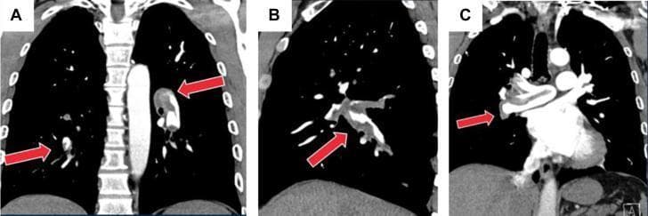 Diagnostic Imaging: A series of three coronal chest CT angiography (CTA) images (labeled A, B, and C) demonstrate a large acute pulmonary embolism. The images reveal a significant saddle embolism characterized by low-attenuation filling defects within the contrast-enhanced pulmonary arterial system. The thrombus is visible at the bifurcation of the main pulmonary artery, extending into both the right and left main pulmonary arteries (indicated by red arrows). In frame C, the large, irregularly shaped filling defect nearly occludes the vessel lumen, while frames A and B show the extension of the thrombus into segmental branches. These findings are clinically significant for acute intermediate-risk pulmonary embolism, illustrating a high-clot-burden obstruction of pulmonary blood flow. The surrounding lung parenchyma appears relatively clear in these sections, without immediate evidence of pulmonary infarction or significant pleural effusion.