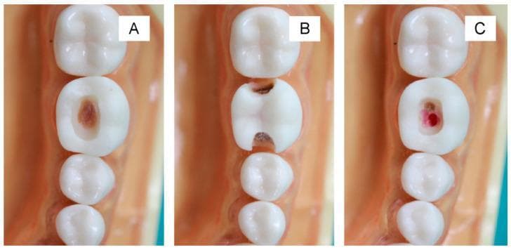 An intraoral clinical photograph set illustrating 3D-printed molar teeth used for dental education on Selective Caries Removal (SCR) techniques. The images demonstrate different cavity preparation outcomes on a permanent left first molar. Image A shows a Black's Class I occlusal cavity with a dark brown material at the base, representing simulated residual caries intentionally left over the pulp to prevent exposure. Image B depicts a Black's Class II proximal-occlusal cavity preparation involving the mesial or distal marginal ridge. Image C shows an over-prepared Class I cavity where red material is visible at the floor, simulating an iatrogenic pulp exposure due to excessive preparation depth. The models are mounted in a realistic pink gingival base. These visual aids are used in operative dentistry to teach students how to manage deep carious lesions by maintaining sound peripheral margins while preserving pulp vitality through conservative caries excavation.