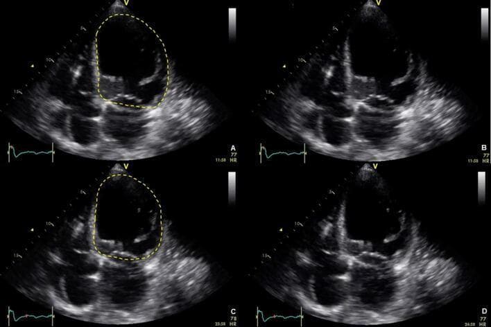 This diagnostic image consists of four echocardiogram frames (A-D) in the apical four-chamber (4C) view, illustrating global left ventricular (LV) dysfunction. The top row (A and B) represents the end-diastolic phase, while the bottom row (C and D) captures the end-systolic phase. In images A and C, the LV endocardium is highlighted with a yellow dashed line to delineate chamber volume. Comparison between the phases reveals minimal change in LV size and shape, indicating a severely reduced ejection fraction. In end-systole (C and D), the LV remains persistently dilated and spherical rather than contracting effectively to a smaller volume, a hallmark of systolic heart failure or dilated cardiomyopathy. The imaging highlights the qualitative assessment ('eyeballing') of LV contractility and the visual discrepancy between end-diastolic volume and end-systolic volume in a dysfunctional heart. These findings are clinically significant for diagnosing impaired global systolic function and managing patients with potential cardiogenic shock or chronic heart failure.