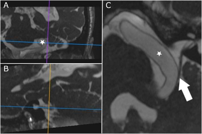Diagnostic Magnetic Resonance Imaging (MRI) using Constructive Interference in Steady State (CISS) sequences, displayed in three panels (A, B, and C) to demonstrate a neurovascular conflict in the posterior fossa. Panel A and B show multiplanar reconstructions with reference lines centered on the cisternal segment of the cranial nerves. Panel C is an oblique axis reconstruction oriented along the cisternal course of the facial (CN VII) and vestibulocochlear (CN VIII) nerves. A prominent, dilated, and elongated basilar artery (marked with a star) is visualized within the prepontine and cerebellopontine angle cisterns. In the oblique view (C), the tortuous artery makes direct contact with and causes mechanical displacement of the nerve bundle (indicated by a white arrow). This imaging demonstrates the anatomical basis for neurovascular compression syndromes, where a dolichoectatic basilar artery indents the vestibulocochlear and facial nerves, potentially leading to symptoms such as hemifacial spasm or vestibular dysfunction. The high-resolution CISS sequence provides excellent contrast between the cerebrospinal fluid, vascular structures, and fine cranial nerve fibers.