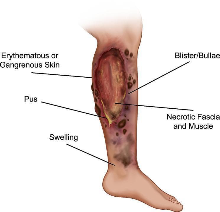 This medical illustration depicts the clinical manifestations of necrotizing fasciitis (NF) on a human lower extremity. The diagram serves as a pathophysiology diagram and clinical guide, labeling key indicators of aggressive soft tissue infection. Centrally, a large ulceration reveals necrotic fascia and muscle, characterized by deep tissue exposure and devitalized appearance. The surrounding cutaneous tissue exhibits significant erythema and gangrenous discoloration, indicating ischemia and advancing tissue death. Associated clinical features include multiple hemorrhagic blisters (bullae), areas of active pus discharge (purulent exudate), and diffuse swelling (edema) extending toward the ankle. This illustration is designed for medical education to assist in the rapid identification of surgical emergencies involving deep-seated infections of the subcutaneous tissue and superficial fascia. Key educational concepts include tissue necrosis, infectious progression, and the distinction between superficial cellulitis and deep-space necrotizing infections.