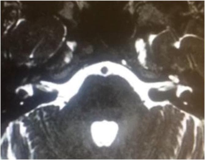 This diagnostic image is an axial T2-weighted MRI focusing on the inner ear and posterior fossa. The scan demonstrates a comparative view of the bilateral cochlear structures. On the left side, the cochlea exhibits a normal high-signal (bright) intensity, indicating the presence of perilymph and endolymph within the membranous labyrinth. In contrast, the right cochlea shows a significant loss of the normal fluid signal, replaced by a darker, hypointense signal intensity and altered morphology characteristic of labyrinthitis ossificans. This finding indicates ossification of the cochlear lumen, a common sequela of bacterial meningitis. The internal auditory canals are visible bilaterally as high-signal intensity fluid-filled channels containing the vestibulocochlear nerve complexes. The pons and cerebellum are visible in the midline and posterior regions, surrounded by bright cerebrospinal fluid. This image is clinically significant for evaluating candidacy for cochlear implantation, as ossification can obstruct electrode insertion.
