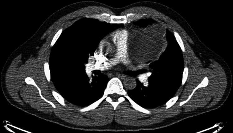 This diagnostic image is an axial contrast-enhanced CT scan of the chest at the level of the pulmonary artery bifurcation. It demonstrates a large, well-defined mass located in the anterior mediastinum, consistent with a mature teratoma. The mass exhibits heterogeneous density with both cystic (hypodense) and solid (isodense to soft tissue) components, a hallmark of germ cell tumors. Spatially, the lesion is situated posterior to the sternum and anterior to the heart and great vessels, causing notable mass effect and lateral displacement of the adjacent mediastinal structures and the left lung. The presence of varying internal attenuation suggests different tissue types, such as fat, fluid, or soft tissue. This clinical finding is significant for differential diagnosis of anterior mediastinal masses, which includes the '4 Ts': Thymoma, Teratoma, Thyroid (retrosternal goiter), and 'Terrible' lymphoma.