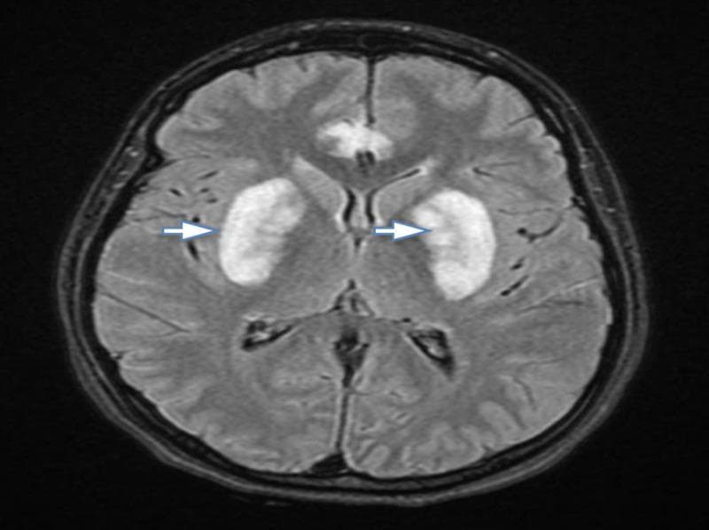 This diagnostic image is an axial Fluid-Attenuated Inversion Recovery (FLAIR) magnetic resonance imaging (MRI) scan of the brain. The image demonstrates prominent, symmetrical hyperintensities localized within the bilateral basal ganglia, specifically involving the putamina (indicated by white arrows). Additionally, a smaller, heterogeneous area of increased signal intensity is visible in the anterior midline of the cerebral parenchyma. These visual findings are characteristic of bilateral putaminal necrosis, often associated with acute toxic metabolic encephalopathy, such as methanol poisoning. The image highlights key radiological features used in neuroradiology for identifying toxic insults to the deep gray matter structures. It serves as an educational example for medical students and clinicians in identifying specific imaging patterns related to systemic toxicity and high-anion gap metabolic acidosis.