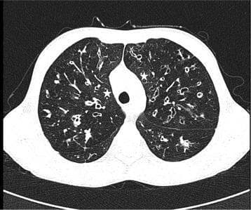 This diagnostic image is a thin-section high-resolution computed tomography (HRCT) axial reconstruction of the chest from a 15-year-old male with cystic fibrosis (CF). The image demonstrates severe bilateral bronchiectasis, characterized by significant bronchial dilatation. Multiple instances of the 'signet ring sign' are visible, where the internal diameter of the bronchus is larger than its accompanying pulmonary artery. There is a notable lack of normal bronchial tapering, with dilated airways extending into the lung periphery and visible within 1 cm of the pleural surface. The parenchyma shows mosaic attenuation; areas of decreased CT attenuation consistent with air trapping are observed in the central parenchyma, while regions marked with asterisks represent areas of relatively normal lung attenuation. The findings illustrate advanced chronic suppurative lung disease and small airway involvement common in pediatric CF patients with impaired pulmonary function (FEV1 45%).