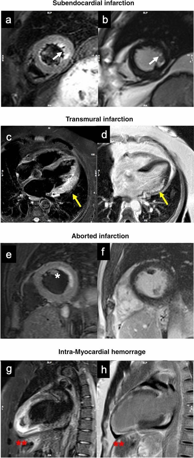 This diagnostic image set showcases Cardiac Magnetic Resonance (CMR) patterns for various myocardial conditions including STEMI and NSTEMI. Panels a and b (short-axis) illustrate a subendocardial infarction in a lateral NSTEMI case, where white arrows highlight localized edema on Short Tau Inversion Recovery (STIR) and late gadolinium enhancement (LGE) on Phase Sensitive Inversion Recovery (PSIR) sequences. Panels c and d demonstrate a transmural infarction with yellow arrows indicating full-thickness edema and LGE in the infero-lateral segments, accompanied by left ventricular dilation. Panels e and f represent an 'aborted' myocardial infarction, showing mid-lateral subendocardial edema (asterisk) on STIR without corresponding LGE enhancement. Finally, panels g and h (long-axis) identify intramyocardial hemorrhage (IMH) following an anterior STEMI, visualized as a distinct dark region of signal loss (red asterisks) within the inferior apical myocardium. These images serve as educational benchmarks for distinguishing tissue viability, infarct transmurality, and microvascular complications using CMR tissue characterization.