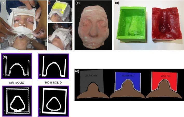 This composite educational graphic illustrates the fabrication process and comparative internal structures of nasal radiation therapy boluses. Panels (a) and (b) show the clinical procedure of creating a plaster facial impression using alginate and Plaster of Paris to ensure patient-specific anatomical fit. Panel (c) compares a hollow 3D-printed Polylactic Acid (PLA) shell (green) with a traditional manually manufactured solid wax bolus (red). Panel (d) displays diagnostic CT cross-sections showing the difference in internal density between an 18% infill and a 100% solid infill 3D-printed shell, highlighting technical variations in additive manufacturing. Panel (e) provides schematic illustrations of the finished bolus types: a solid wax bolus (grey), a 3D-printed shell with water fill (blue), and a 3D-printed shell with wax fill (red), each shown fitted to a facial contour. The content is designed for radiation oncology training, emphasizing the transition from manual molding to high-precision 3D-printed tissue-equivalent materials to optimize dose distribution and surface conformity during treatment.
