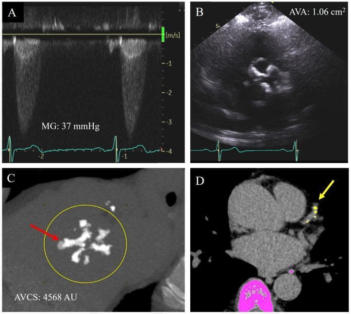 This four-panel image illustrates a multimodal diagnostic approach for assessing aortic stenosis severity in a patient with a bicuspid aortic valve. Panel A shows a spectral Doppler echocardiogram measuring a mean systolic pressure gradient (MG) of 37 mmHg, while Panel B provides a 2D transthoracic echocardiogram in short-axis view calculating an aortic valve area (AVA) of 1.06 cm². Both ultrasound panels include concurrent ECG monitoring. Panel C displays a non-contrast cardiac CT cross-section of the aortic valve, revealing extensive, dense, and irregular calcifications within the leaflets (red arrow). A yellow circular ROI highlights the area used to determine an Aortic Valve Calcium Score (AVCS) of 4568 Agatston Units (AU), a value indicative of severe stenosis. Panel D is a cardiac CT axial slice showing concurrent coronary artery calcification within the left anterior descending (LAD) coronary artery (yellow arrow), with pink and yellow automated overlays used for calcium quantification. The collection demonstrates how cardiac CT calcium scoring can resolve diagnostic discordance in echocardiographic parameters for valvular heart disease.