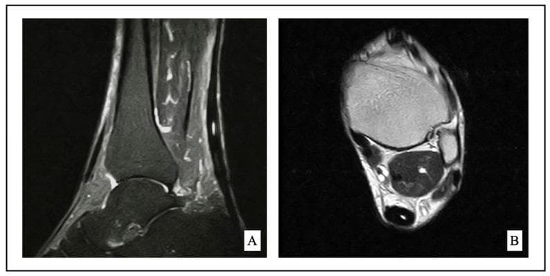 This diagnostic image consists of two MRI views of the ankle demonstrating midportion Achilles tendinopathy. Panel A is a sagittal fat-saturated MRI, which highlights fluid and edema as high-signal intensity. It reveals a thickened Achilles tendon with internal high-signal changes and disruption of the normal linear fibrillar pattern, characteristic of tendinosis and chronic inflammation. Adjacent structures including Kager's fat pad and the retrocalcaneal region show subtle reactive changes. Panel B is an axial T1-weighted MRI providing a cross-sectional view of the mid-tendon. This view demonstrates focal fusiform thickening (hypertrophy) and loss of the normal anterior concave or flat border of the Achilles tendon. The surrounding paratenon and soft tissues are visualized to assess for paratenonitis or fluid collections. These images are clinically significant for orthopedic and radiological evaluation of chronic Achilles tendon pathology, often used to guide management decisions between conservative physical therapy and surgical debridement.