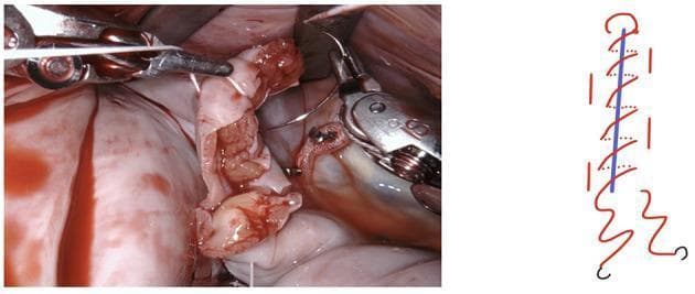 This composite image consists of an intraoperative clinical photograph and a corresponding schematic diagram illustrating a surgical suturing technique. The clinical photograph on the left shows an active surgical field, likely within the thoracic or abdominal cavity, involving a robotic-assisted surgical system. Robotic graspers and needle drivers are visible manipulating pale, serosal tissue and adjacent reddish vascularized tissue. A white monofilament suture is being used to perform a closure. To the right, a simplified line diagram demonstrates the logic of a simple continuous suture pattern. In the diagram, a central blue line represents the incision or approximation line, while a red winding line illustrates the path of the needle and thread as it creates successive loops to provide even tension across the wound. This educational material is designed for surgical trainees to understand the application of a second layer of continuous reinforcement sutures during complex reconstructive procedures.