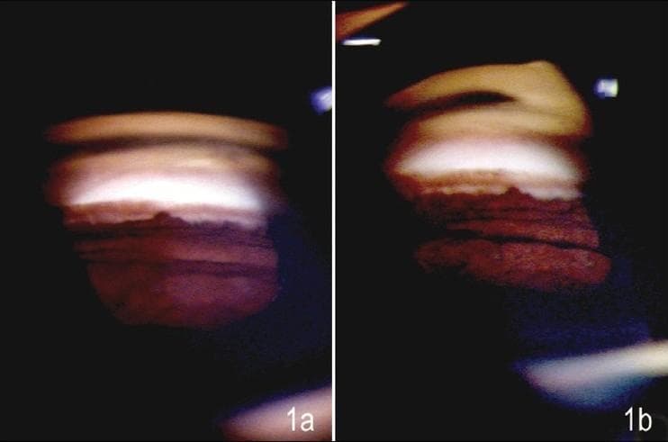 This comparative clinical diagnostic image displays a side-by-side gonioscopic evaluation of the anterior chamber angle in a 45-year-old patient. The images illustrate a clinical diagnostic challenge: the differentiation between true peripheral anterior synechiae (PAS) and a pseudosynechia caused by a peripheral iris bulge. Image (1a) was captured using a Goldmann (two-mirror) lens, showing a prominent horizontal ridge and reddish-brown tissue extending toward the trabecular meshwork, mimicking a synechia in a wide-open angle. Image (1b) shows the same anatomical region viewed with a Sussman (four-mirror) lens. The visual characteristics include a granular iris texture and a reflective band at the top representing the posterior corneal surface/Schwalbe's line. The primary educational objective is to demonstrate how indentation gonioscopy (possible with the Sussman lens) helps flatten the peripheral iris bulge to reveal the underlying anatomy, whereas manipulative gonioscopy with a Goldmann lens may fail to resolve the pseudosynechia. This is a critical distinction in the evaluation of primary angle-closure suspects and glaucoma management.