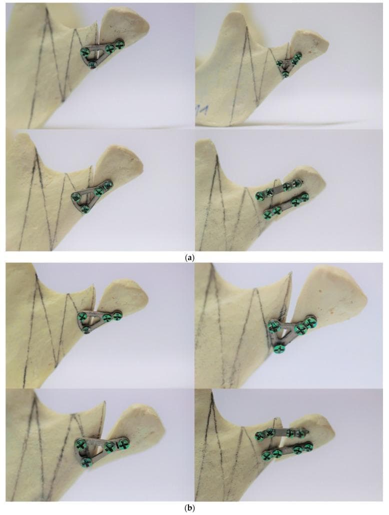 This clinical photograph shows a biomechanical study of various osteosynthesis plate designs used for the rigid fixation of mandibular high-neck condylar fractures. The material consists of a polyurethane mandible model, which mimics the mechanical properties of human cancellous bone. Part (a) displays four different titanium plate designs (triangular, trapezoidal, and double-plate configurations) secured across simulated fracture lines before mechanical loading. The plates are fixed with medical-grade screws into both the proximal and distal mandibular fragments, showing proper alignment and structural integrity. Part (b) illustrates the same specimens after fatigue testing, demonstrating various degrees of mechanical failure and material fatigue. Visible changes include significant plate deformation (bending), loss of anatomical reduction at the fracture site, and screw loosening or displacement. This comparison is used in oral and maxillofacial surgery research to evaluate the stability and durability of different internal fixation systems for condylar process fractures under simulated physiological loads.