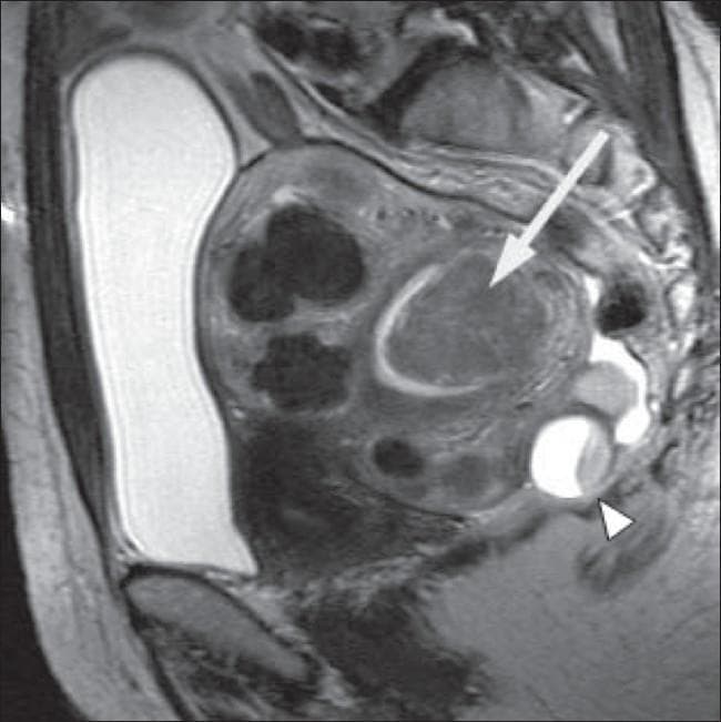 This sagittal T2-weighted MRI scan of the pelvis demonstrates a bulky, retroverted uterus with multiple leiomyomas (uterine fibroids). Several intramural fibroids are visible as well-defined, low-signal intensity (hypointense) solid masses within the myometrium. A large submucosal fibroid, indicated by a white arrow, is shown projecting into and significantly distorting the endometrial cavity, which is a common visual hallmark of symptomatic menorrhagia. Posterior to the uterus, a complex cystic structure is visible, indicated by a white arrowhead; it exhibits internal signal heterogeneity and fluid levels consistent with a complex ovarian cyst. The image illustrates key radiological features for classifying fibroids by anatomical location (submucosal vs. intramural) and demonstrates incidental adnexal findings. This diagnostic image is intended for intermediate to advanced medical education regarding gynecological imaging and pelvic pathology.