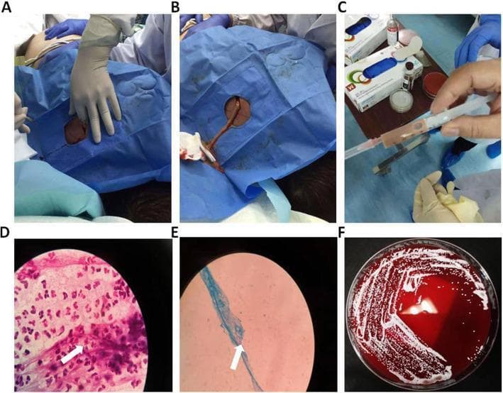 A six-panel figure documenting the clinical management and microbiological diagnosis of a subcutaneous back abscess, indicative of disseminated nocardiosis. Panels A and B show intraoperative clinical photographs of the incision and subsequent drainage of the abscess site on the patient's back, which is draped in sterile blue material. Panel C displays a syringe containing aspirated greyish-white, turbid purulent fluid. Panel D presents a Gram stain micrograph showing a dense inflammatory infiltrate composed predominantly of neutrophils (pink) and scattered gram-positive cocci/branching filaments (purple, white arrow). Panel E demonstrates a weak acid-fast stain (Kinyoun method) identifying characteristic blue-stained filamentous bacteria (white arrow), a hallmark of Nocardia species. Panel F shows a Columbia Blood Agar plate after incubation, exhibiting confluent growth of small, white to off-white bacterial colonies with evidence of beta-hemolysis. This composite illustrates the diagnostic pathway from clinical intervention to specialized microbiological staining and culture for identifying infectious pathogens.