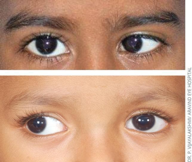 This comparison clinical photograph illustrates two common forms of strabismus (ocular misalignment) in pediatric patients, specifically focusing on horizontal deviations and the Hirschberg test (corneal light reflex). The top panel displays left esotropia, where the left eye is deviated medially (inward) relative to the fixating right eye; consequently, the corneal light reflex on the left eye is displaced temporally from the pupillary center. The bottom panel displays right exotropia, characterized by the lateral (outward) deviation of the right eye relative to the fixating left eye; here, the corneal light reflex on the right eye is displaced nasally. These images serve as an educational tool for ophthalmology and pediatrics to demonstrate the clinical manifestation of manifest strabismus (tropia) and the use of light reflex symmetry to identify ocular misalignment. The content is suitable for medical students and residents learning basic ophthalmic examination techniques and the diagnosis of binocular vision disorders.