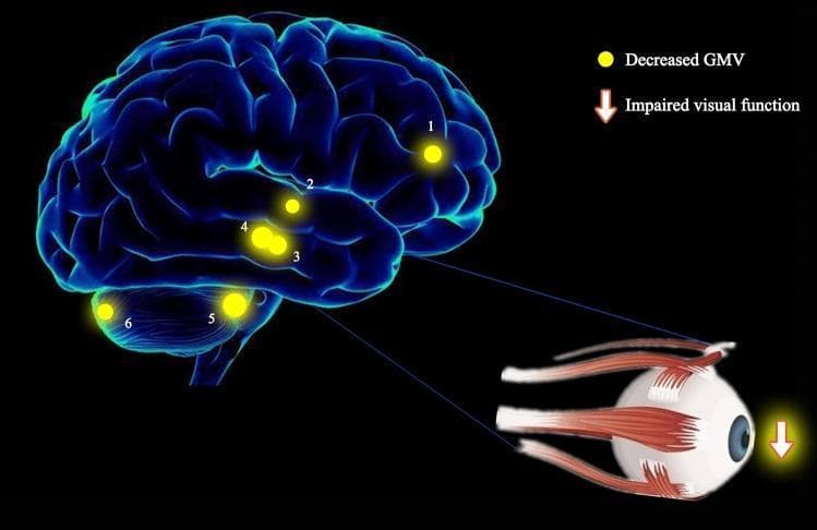 This medical illustration combines a three-dimensional brain rendering and an anatomical ocular diagram to demonstrate the pathophysiology of strabismus with amblyopia (SA). The brain model highlights six specific regions with decreased gray matter volume (GMV), indicated by numbered yellow spots: (1) left anterior cingulate, (2) right superior temporal gyrus, (3) right parahippocampal gyrus, (4) left parahippocampal gyrus, (5) right anterior lobe of the cerebellum, and (6) right posterior lobe of the cerebellum. The size of these spots represents the degree of quantitative change in GMV. A detailed illustration of the human eye, including extraocular muscles, is connected to the parahippocampal regions (3 and 4) via blue lines, suggesting a functional link. A downward-pointing arrow next to the eye signifies 'impaired visual function.' This visual summary illustrates research findings where significant GMV reduction in these specific cortical and cerebellar areas correlates with the visual and oculomotor deficits characteristic of patients with SA compared to healthy controls.