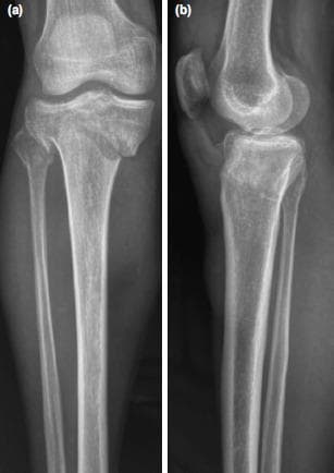 This diagnostic radiographic image consists of two views of the knee: (a) an antero-posterior (AP) view and (b) a lateral view, demonstrating a complex bicondylar tibial plateau fracture classified as Schatzker Type VI. The AP view reveals extensive comminution and disruption of both the medial and lateral tibial condyles, with multiple fracture lines extending from the articular surface through to the metaphysis. Significant distortion of the tibial plateau's anatomical contour is evident, along with a fracture of the proximal fibula. The lateral view demonstrates a complete dissociation between the tibial metaphysis and diaphysis. There is visible articular incongruity, depression of the joint surface, and significant anterior-posterior displacement of the fracture fragments. The images illustrate a high-energy orthopedic injury characterized by metaphyseal-diaphyseal discontinuity, which is the defining feature of the Schatzker VI classification. This content is highly relevant for orthopedic surgical planning, trauma education, and musculoskeletal radiology indexing.