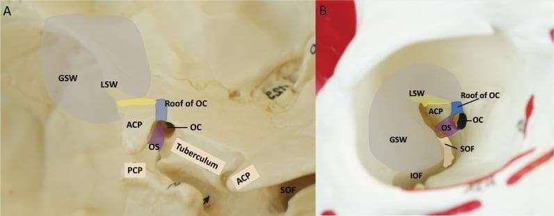 This educational anatomical diagram consists of two panels (A and B) illustrating the bony anatomy and supporting structures of the anterior clinoid process (ACP) within the human skull base. Panel A provides a left oblique intracranial view, identifying the three roots of the ACP: the lateral root connecting to the lesser wing of the sphenoid (LSW, yellow), the anterior root forming the roof of the optic canal (OC, blue), and the posterior root known as the optic strut (OS, purple). Surrounding landmarks include the greater wing of the sphenoid (GSW), posterior clinoid process (PCP), superior orbital fissure (SOF), and the tuberculum sellae. Panel B displays a right intra-orbital view, showing the same colored structures from an endoscopic perspective. This panel highlights the spatial relationship between the ACP, the optic canal, and the superior and inferior orbital fissures (IOF). The gray shaded area represents the planned craniotomy for an endoscopic transorbital approach (ETOA). The visual serves to define critical landmarks for neurosurgical procedures like anterior clinoidectomy.