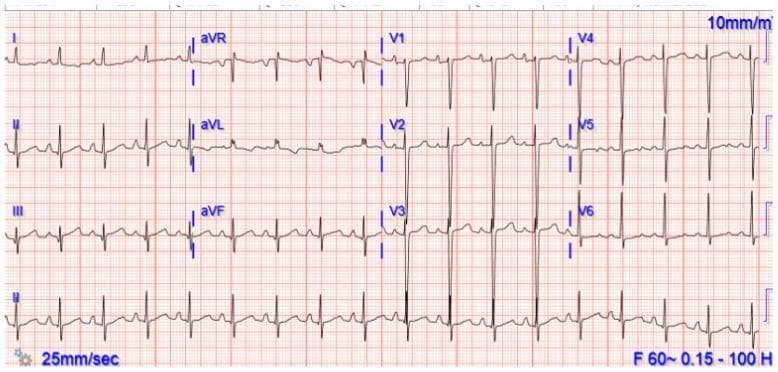 This diagnostic image is a 12-lead electrocardiogram (ECG) printed on standard grid paper at a speed of 25 mm/sec and calibration of 10 mm/mV. The tracing demonstrates a regular, narrow-complex rhythm with a heart rate exceeding 100 beats per minute, consistent with sinus tachycardia. P waves are identifiable before each QRS complex, indicating a sinus origin, though they are positioned close to the preceding T waves due to the rapid rate. The limb leads (I, II, III, aVR, aVL, aVF) show a normal electrical axis, with upright QRS complexes in leads I and II and inversion in lead aVR. Precordial leads (V1-V6) show normal R-wave progression. While ST segments and T waves are largely unremarkable, the high heart rate necessitates careful evaluation for subtle ischemia or conduction abnormalities. This ECG is representative of cardiovascular assessment in clinical scenarios like acute myocarditis, autonomic dysfunction, or compensatory physiological responses.