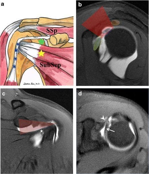 This composite educational resource illustrates the anatomy of the rotator interval of the shoulder. (a) An anatomical diagram of the left shoulder in external rotation highlights the rotator cuff interval (green star) located between the supraspinatus (SSp) and subscapularis (SubScp) tendons, with the long head of the biceps tendon (blue asterisks) traveling in the bicipital groove. (b-d) T1-weighted TSE fat-suppressed MR arthrography images in sagittal, coronal, and axial planes demonstrate the interval using contrast enhancement. In the sagittal view (b), the interval (red overlay) is flanked by the subscapularis (green) and supraspinatus (orange), with the biceps tendon (blue) centrally located. The coronal view (c) defines the triangular interval boundaries, bordered inferiorly by the subscapularis tendon (asterisk). The axial view (d) provides detailed visualization of the long head of the biceps brachii tendon (arrow) and the coracohumeral ligament (arrowhead) within the interval. This content demonstrates the anterior-rotator interval approach for intra-articular injection, emphasizing the preservation of the inferior glenohumeral ligament and subscapularis muscle integrity.
