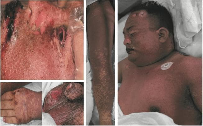 This composite clinical photograph illustrates the multisystem dermatological manifestations of Toxic Epidermal Necrolysis (TEN). The images demonstrate widespread epidermal detachment and mucocutaneous involvement across several anatomical regions. Facial views show significant erosions, hemorrhagic crusting, and denuded skin around the periorbital and perioral areas, characteristic of severe mucosal involvement. The trunk and upper extremities exhibit a confluent, dusky erythematous maculopapular rash with areas of epidermal sloughing and blistering, resulting in large patches of exposed, raw dermis. A detailed view of the genitalia reveals severe epidermal loss and ulceration, highlighting the involvement of non-oral mucosal surfaces. The hand and arm images show a mix of discrete and confluent erythematous lesions with positive Nikolsky-like signs of skin fragility. This visual presentation is indicative of a severe Cutaneous Adverse Reaction (SCAR), demonstrating the high morbidity associated with extensive integumentary failure and the critical need for intensive wound management in TEN cases.