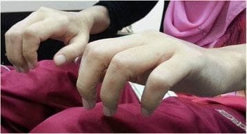 This clinical photograph displays the hands of a patient with Nephrogenic Systemic Fibrosis (NSF), a rare systemic disorder occurring in individuals with renal failure. The image prominently features scleroderma-like changes, characterized by significant tightening, thickening, and induration of the skin across the dorsum of the hands and fingers. Marked joint contractures are visible, particularly in the proximal interphalangeal (PIP) and metacarpophalangeal (MCP) joints, resulting in a 'claw-hand' deformity and severely restricted range of motion. The skin appears taut, waxy, and shiny, with a loss of normal skin creases and prominence of underlying skeletal structures. This presentation illustrates the aggressive fibrotic process of NSF following gadolinium-based contrast exposure in a patient with end-stage renal disease. The visual evidence emphasizes the debilitating physical impact of the condition on manual dexterity and joint function.