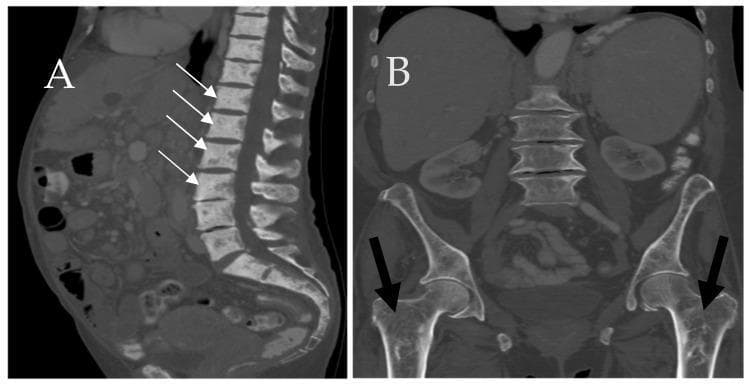 This dual-panel figure displays computed tomography (CT) scans of the skeletal system in a patient with systemic mastocytosis. Image A is a sagittal CT of the lumbar and sacral spine, demonstrating diffuse osteosclerosis of the axial skeleton. White arrows indicate multiple vertebral bodies showing pathologically increased bone density with a patchy, sclerotic appearance. Image B is a coronal CT of the pelvis and proximal femurs, where black arrows highlight a diffuse loss of normal trabecular architecture. The proximal femurs exhibit a heterogeneous, osteolytic, and somewhat 'mottled' internal structure, indicative of bone marrow infiltration. The images collectively illustrate the varied osseous manifestations of mast cell infiltration, ranging from lytic-appearing trabecular loss to profound focal or diffuse sclerosis. These findings are clinically significant for the radiological evaluation of hematologic malignancies and metabolic bone diseases.