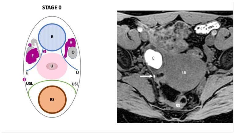 This dual-panel image provides a comparison between a schematic diagram and an axial T1-weighted fat-saturated MR image illustrating 'Stage 0' pelvic endometriosis. The left panel is a labeled diagram identifying key pelvic anatomy including the bladder (B), uterus (U), rectosigmoid (RS), ovaries (O), and uterosacral ligaments (USL). It highlights an endometrial cyst (E), hematosalpinx (H), and superficial peritoneal implants (i). The right panel shows a corresponding diagnostic MR image of the female pelvis. A prominent hyperintense (bright) cystic lesion labeled 'E' represents an ovarian endometrioma, characteristic of blood-filled contents on T1-weighted fat-saturated sequences. Adjacent to this, a white arrow indicates a small focus of intermediate-to-high signal intensity corresponding to a superficial peritoneal implant located near the uterosacral ligament and rectosigmoid (RS). Other visible landmarks include the uterus (Ut) and pelvic musculature. The image demonstrates the diagnostic criteria for early-stage endometriosis (Endo-Stage MRI classification), focusing on the identification of superficial lesions and ovarian involvement without deep pelvic infiltration.
