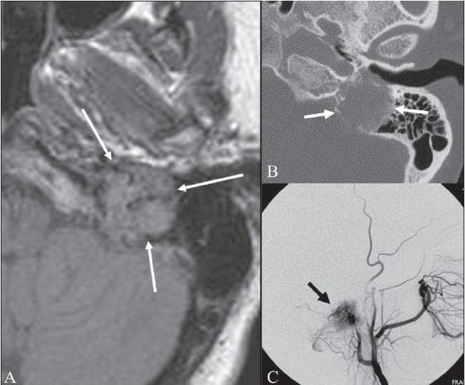 This composite educational image illustrates the diagnostic features of a glomus jugulare tumor (paraganglioma) within the left temporal bone through three imaging modalities. Panel A is an axial FLAIR MRI showing a heterogeneous, predominantly isointense mass in the jugular foramen region. It exhibits the characteristic 'salt and pepper sign,' where 'pepper' represents hypointense signal voids from high-flow vessels and 'salt' represents hyperintense foci from slow-flow vessels or hemorrhage. Panel B is an axial CT scan of the same anatomical region, highlighting the aggressive nature of the lesion through visible destruction and permeative erosion of the surrounding petrous temporal bone and jugular fossa (indicated by arrows). Panel C is an external carotid angiogram demonstrating a dense 'tumor blush' (black arrow), confirming the hypervascular nature of the mass. These multimodal findings—hypervascularity on angiography, bony destruction on CT, and the salt-and-pepper appearance on MRI—are pathognomonic for a glomus jugulare tumor. This content is intended for advanced medical education in neuroradiology and otolaryngology.