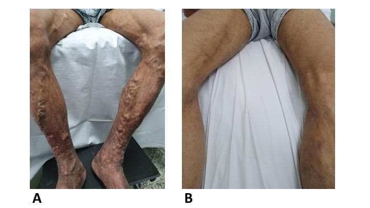 This clinical comparison photograph illustrates the effectiveness of ultrasound-guided foam sclerotherapy for advanced chronic venous insufficiency. Image A (pre-procedure) shows bilateral lower extremities with severe, tortuous varicosities of the great saphenous vein tributaries. Prominent, bulging venous networks are visible from the distal thighs to the ankles, accompanied by cutaneous signs of chronic venous stasis, including hyperpigmentation and skin textural changes. Image B (two weeks post-procedure) demonstrates the same patient's legs after a single session of 3% and 1% polidocanol foam sclerotherapy. There is a marked reduction in the size and prominence of the varicose veins, with a smoother skin surface and decreased venous protrusion. The comparison highlights the rapid clinical involution of symptomatic varicosities following foam injection and subsequent clot drainage. This visual is intended for vascular surgery and dermatology education, focusing on the management of venous disease and minimally invasive treatment outcomes.