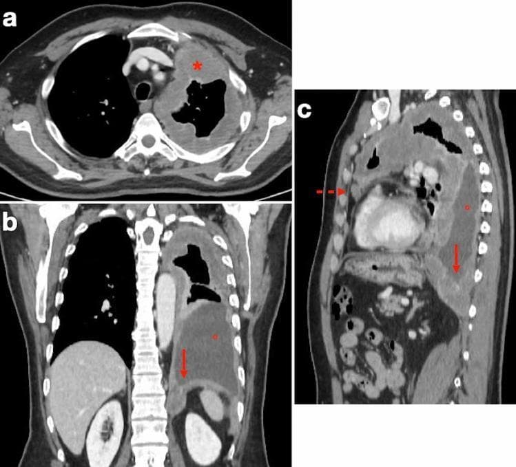 This composite diagnostic image features three contrast-enhanced multidetector CT views (axial, coronal, and sagittal) of a 72-year-old male with a history of asbestos exposure, illustrating the staging of pleural mesothelioma. (a) The axial CT scan at the mid-thoracic level reveals diffuse, irregular, rind-like soft tissue enhancement causing marked pleural thickening that circumferentially encases the left lung. (b) The coronal reconstruction demonstrates a large, loculated pleural effusion in the left hemithorax and clear infiltration of the ipsilateral hemidiaphragm by the enhancing tumor mass. (c) The sagittal view highlights the invasion of the epicardial fat planes, characterized by a lack of distinct demarcation between the tumor and the pericardial layer. Key educational concepts include identifying the 'pleural rind' sign of malignancy, assessing transdiaphragmatic extension, and evaluating the loss of mediastinal fat planes to determine tumor resectability. These findings are consistent with advanced-stage pleural mesothelioma in the context of occupational exposure.