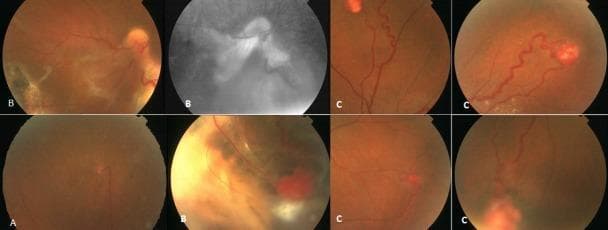 This set of fundus photographs illustrates various clinical presentations of retinal capillary hemangiomas, commonly associated with Von Hippel-Lindau disease. Panel A displays a small, isolated superior retinal capillary hemangioma in the right eye, characterized by a circumscribed reddish lesion. Panels labeled B demonstrate a large, complex hemangioma in the right eye, complicated by an extensive serous retinal detachment and a visible gray-white cryotherapy scar. These images include a red-free or grayscale view highlighting the vascular alterations and exudative changes. Panels labeled C show multiple, multifocal retinal capillary hemangiomas in the left eye, featuring characteristic dilated, tortuous feeder and drainer vessels leading to the orange-red tumors. The educational focus is on the spectrum of disease severity, from small asymptomatic lesions to large tumors with vision-threatening complications like exudative detachment, and the typical vascular morphology used for diagnostic identification in ophthalmology.