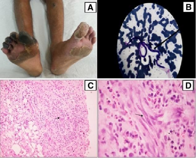 Educational multi-panel figure illustrating the clinical and pathological findings of lymphatic filariasis (Wuchereria bancrofti) masquerading as vasculitis. Panel A (Clinical Photograph): Displays the lower extremities of a patient with dry gangrene of the right hallux and lesser digits, alongside an ulcerated nodule on the left shin and diffuse skin excoriation, indicating severe peripheral vascular compromise. Panel B (Peripheral Blood Film): Giemsa-stained blood smear showing a characteristic microfilaria (approximately 240-250 um long) with identifiable micromorphological features. Panels C and D (Histopathology): Haematoxylin and Eosin (H&E) stained skin biopsy sections from the shin nodule. Low-power magnification (C, 100x) reveals dense inflammatory infiltrates spanning the dermis and subcutaneous fat with capillary proliferation. High-power magnification (D, 1000x) demonstrates a microfilaria (arrow) localized within a capillary lumen, surrounded by a mixed inflammatory cell population consisting of plasma cells, lymphocytes, and neutrophils. This visual set demonstrates the importance of parasitic evaluation in cases of atypical limb ischemia and nodular skin lesions.