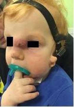 Clinical photograph of a pediatric patient presenting with an infected nasal dermoid cyst. The primary pathology is a prominent midline mass located on the nasal dorsum/glabella region. Visually, the mass exhibits an erythematous, reddish-purple hue with an irregular, textured surface suggestive of acute inflammation or secondary infection. Associated periorbital edema and soft tissue swelling are evident around the lesion. The image also demonstrates medical support and devices, including a tracheostomy tube positioned beneath the chin, a pacifier in the mouth, and a headgear strap, indicating possible complex airway management or comorbid conditions. This visual serves to educate on the typical midline presentation of congenital nasal dermoid cysts and the clinical signs of superimposed infection in a surgical candidate.