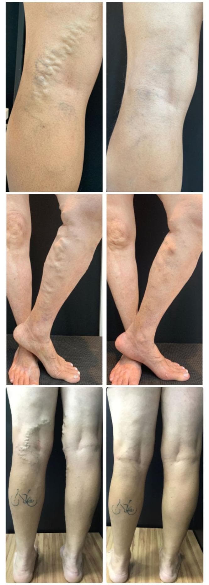 This composite clinical photograph displays three sets of side-by-side 'before' and 'after' images of the lower extremities in patients undergoing assisted total thermal ablation (ATTA) for chronic venous insufficiency. The 'before' images (left) demonstrate classic clinical signs of varicose veins, including prominent, bulging, and tortuous superficial venous segments along the medial thigh, popliteal fossa, and calf. These vessels appear rope-like with visible skin elevation and bluish discoloration. In the corresponding 'after' photographs (right), there is a significant reduction in venous prominence, resulting in a smoother skin contour and improved aesthetic appearance. The secondary and tertiary sets show the resolution of large tributary varicosities on the shins and posterior legs, with one image showing a subtle postoperative scar. These images illustrate the efficacy of endolaser thermal ablation in treating both axial saphenous veins and their associated tributaries, facilitating objective assessment of clinical outcomes in vascular surgery and phlebology.