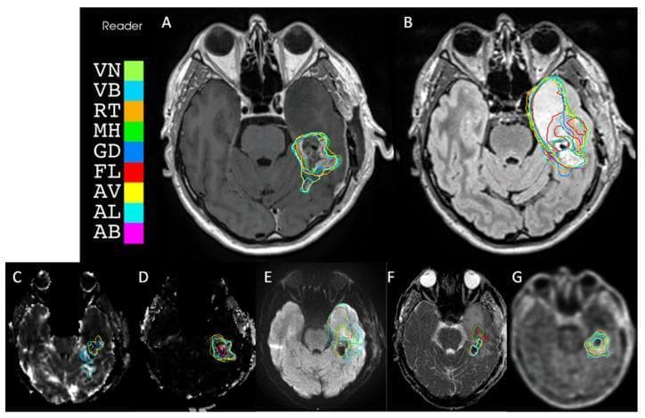 This composite diagnostic image displays axial brain imaging modalities used to evaluate a contrast-enhancing lesion in the left temporal-frontal region, likely a high-grade glioma. The panel illustrates multi-parametric MRI and PET/CT sequences including: (A) T1-weighted gadolinium-enhanced MRI showing a ring-enhancing mass with central necrosis; (B) T2-FLAIR showing hyperintense peritumoral edema; (C) Relative cerebral blood volume (rCBV) and (D) K2 permeability maps indicating tumor vascularity; (E) Diffusion-weighted imaging (DWI b1000) and (F) Apparent Diffusion Coefficient (ADC) map assessing cellularity and restricted diffusion; and (G) 18F-FET PET/CT showing metabolic activity via radiotracer uptake. Each image features superimposed color-coded contours representing volume segmentations from ten different readers (VN, VB, RT, MH, GD, FL, AV, AL, AB). The visual comparison highlights inter-observer variability in defining tumor boundaries across morphological, functional, and metabolic imaging. This material is designed for neuro-radiology and oncology education, specifically regarding target volume delineation and the integration of advanced imaging in neuro-oncology workflows.