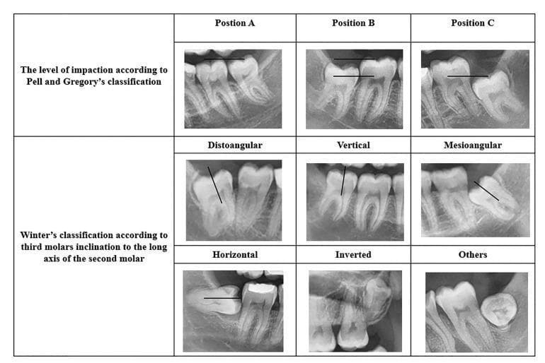 A composite image displaying nine panoramic dental radiographs categorized by two standard systems for classifying impacted mandibular third molars: the Pell and Gregory classification and Winter's classification. The top row illustrates the Pell and Gregory system based on the vertical depth of the impacted tooth relative to the second molar: Position A (at the occlusal plane), Position B (between the occlusal plane and cementoenamel junction), and Position C (below the CEJ). The bottom two rows demonstrate Winter's classification based on the angulation of the long axis of the third molar relative to the second molar or occlusal plane. Visualized categories include distoangular (tilted away from the second molar), vertical (parallel), mesioangular (tilted toward the second molar), horizontal (90-degree tilt), inverted (crown facing downward), and other atypical positions. These radiographic examples serve as an educational diagnostic guide for oral and maxillofacial surgery planning and risk assessment.