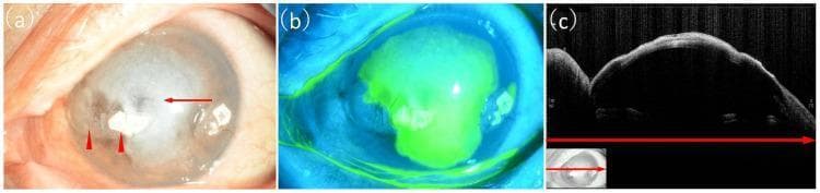 A multi-panel ophthalmological clinical study of the left eye demonstrating severe infectious keratitis. Panel (a) is a slit-lamp photograph showing extensive white corneal infiltration covering over two-thirds of the cornea (red arrow), associated with a deep ulcer extending into the anterior stroma, large epithelial defects, and mild conjunctival hyperemia. Calcium deposits consistent with band-shaped keratopathy are visible in the peripheral cornea (red arrowheads). Panel (b) presents a fluorescein-stained photograph under cobalt blue light, revealing a large, bright green fluorescent area indicating a significant loss of epithelial integrity and an extensive active corneal ulcer. Panel (c) is an anterior segment optical coherence tomography (AS-OCT) cross-section showing marked hyperreflectivity of the corneal epithelium and the superficial stroma, corresponding to the areas of infiltration and ulceration (indicated by red arrows). This imaging set illustrates the diagnostic workup for complex infectious keratitis, likely fungal in origin given the recalcitrant nature and clinical morphology.