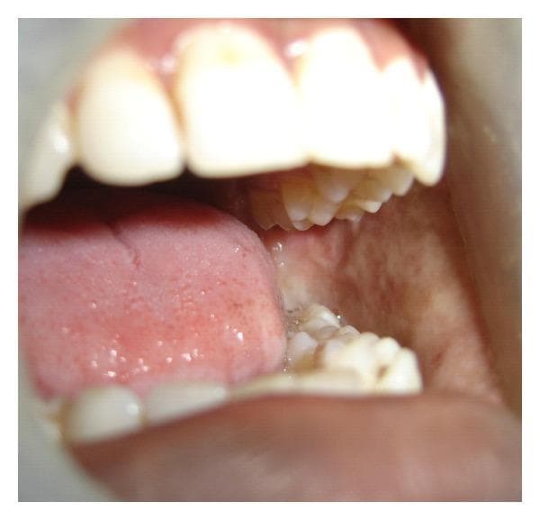 This clinical photograph shows an intraoral view of a patient with oral submucous fibrosis (OSMF). The primary feature is the presence of pale, blanched, and fibrotic buccal mucosa, most notable on the left side of the image. The healthy pink color is replaced by whitish fibrous bands and a marble-like appearance, indicating significant submucosal collagen deposition and reduced vascularity. The oral cavity exhibits restricted mouth opening (trismus), as evidenced by the limited interincisal distance and the close proximity of the tongue and teeth. The tongue is positioned low in the oral cavity, showing normal dorsal papillae, but its mobility is clinically constrained by the surrounding fibrotic tissues. This image serves as a classic educational example of the clinical presentation of OSMF, a premalignant condition often associated with areca nut or tobacco use, characterized by progressive stiffness of the oral mucosa and significant functional impairment in jaw movement.