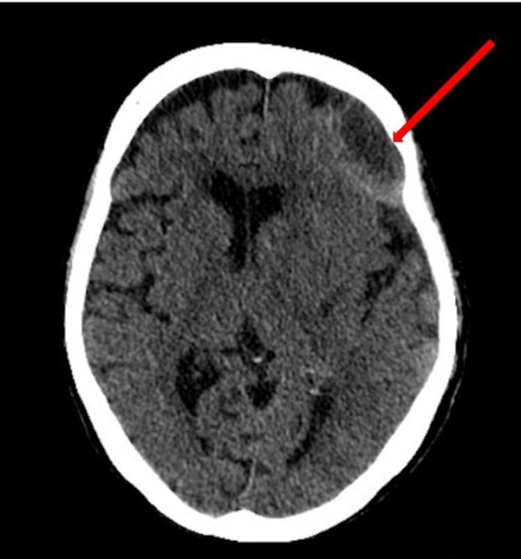 This diagnostic image is an axial non-contrast Computed Tomography (CT) scan of the brain demonstrating a large, multiloculated chronic subdural hematoma in the left frontal region. The hematoma is characterized by a crescent-shaped, predominantly hypodense collection relative to the brain parenchyma, indicated by a red arrow. The collection is situated between the inner table of the skull and the brain surface, exerting a significant mass effect. Visual evidence of this mass effect includes compression and distortion of the adjacent left frontal lobe and effacement of the nearby sulci. Furthermore, there is a distinct midline shift of approximately 7 mm toward the right side, as evidenced by the displacement of the falx cerebri and the lateral ventricles from the median plane. This image illustrates key radiological findings associated with significant intracranial volume expansion and secondary structural distortion. It is used in medical education to teach the diagnostic identification of subdural collections and the assessment of mass effect on intracranial anatomy.