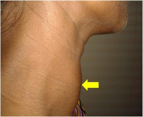 This clinical photograph shows a right lateral view of the neck of a 30-year-old female patient, demonstrating a diffusely enlarged thyroid gland, also known as a goiter. The anatomical region of interest is the anterior neck, where a significant convex protrusion is visible, indicated by a yellow arrow. The swelling appears symmetrical and smooth-surfaced, consistent with a diffuse rather than nodular enlargement of the thyroid lobes and isthmus. The skin overlying the mass is uniform in color without signs of inflammation, erythema, or ulceration. The neck is held in a slightly extended position to better visualize the anterior contour. This visual finding is characteristic of Graves' disease, as supported by the clinical context of thyrotoxicosis and diffuse radioactive iodine uptake mentioned in the patient's record. This image serves as an educational example of the physical examination findings associated with hyperthyroidism and autoimmune thyroid disease.
