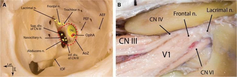 Anatomical diagrams and clinical photographs illustrating the neurovascular structures of the right superior orbital fissure (SOF). Image A provides a frontal schematic view of the bony orbit, highlighting the annulus of Zinn (AoZ) encircling the optic nerve (ON) and ophthalmic artery (OphA). It shows the spatial arrangement of the cranial nerves: the superior and inferior divisions of CN III, the nasociliary nerve, and the abducens nerve (CN VI) are positioned within the annulus. The lacrimal, frontal, and trochlear (CN IV) nerves are shown superior and lateral to the annulus within the fissure. Bony landmarks include the anterior and posterior ethmoidal foramina (AEF, PEF) and the inferior orbital fissure (IOF). Image B is a cadaveric dissection showing the neural anatomy. It depicts the physical relationships between the larger bundles of the oculomotor nerve (CN III), trochlear nerve (CN IV), and the ophthalmic division of the trigeminal nerve (V1) with its frontal and lacrimal branches, alongside the abducens nerve (CN VI) as they converge toward the SOF. This educational material focuses on orbital apex anatomy and the complex arrangement of nerves essential for neurosurgery and ophthalmology.