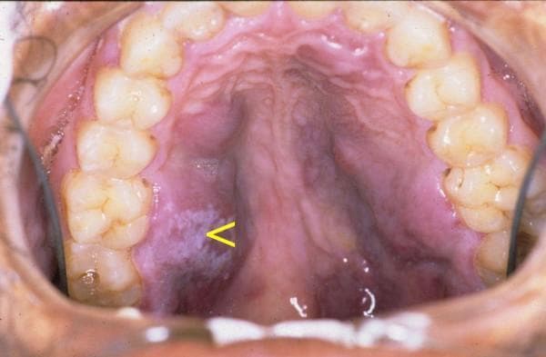 This clinical intraoral photograph displays the hard palate and maxillary dentition of a patient, demonstrating classic oral manifestations of advanced immunodeficiency. The primary findings are multifocal, irregular, purple-to-red maculopapular lesions consistent with Kaposi sarcoma (KS). These vascular lesions exhibit poorly defined margins and vary in texture, appearing as both flat discolorations and slightly elevated plaques across the palatal mucosa. Additionally, a distinct white, patchy, friable-looking area is visible on the left side of the hard palate (indicated by a yellow arrow), characteristic of pseudomembranous candidiasis. The concurrent presentation of oral Kaposi sarcoma and candidiasis is highly suggestive of HIV/AIDS-related complications. The photograph serves as an educational resource for identifying opportunistic infections and neoplastic conditions within the oral cavity, highlighting the clinical appearance of vascular tumors and fungal overgrowth in immunocompromised individuals.