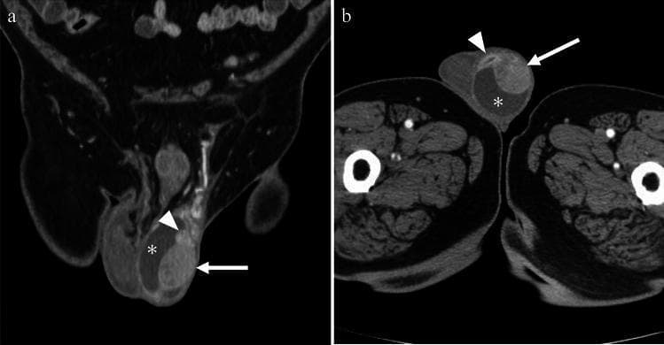 This contrast-enhanced CT study consists of coronal (a) and axial (b) sections of the pelvic and scrotal region, demonstrating findings characteristic of acute epididymo-orchitis with complications. The imaging reveals significant enlargement and intense, heterogeneous contrast enhancement of the left testis (arrow) and left epididymis (arrowhead), indicating severe inflammation and hyperemia. Associated features include marked thickening of the scrotal wall and a reactive hydrocele (asterisk), seen as a hypoattenuating fluid collection surrounding the testicular structures. In the axial view (b), a distinct focal area of non-enhancement with peripheral rim enhancement is visible in close contact with the testis and hydrocele, representing an abscess formation. These radiological findings are critical for diagnosing complicated intrascrotal infections and differentiating them from simple epididymitis or testicular torsion. The image serves as an educational resource for identifying secondary signs of infection such as abscess development and reactive fluid accumulation within the tunica vaginalis.