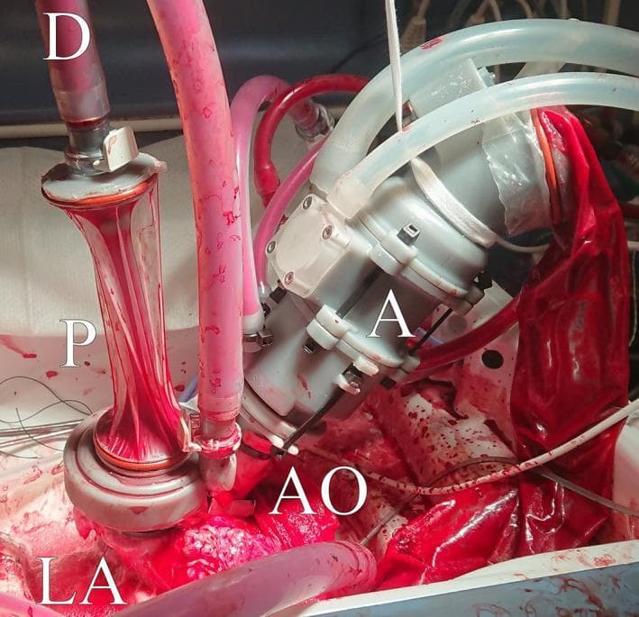 A procedural photograph documenting an ex vivo working heart model setup for hemodynamic research. The central anatomical focus is an isolated heart partially submerged in a perfusate reservoir. On the right, a mechanical afterload device (A), likely based on a Windkessel model, is securely attached to the aorta (AO). This device is a gray, rigid-shelled component containing a compliant internal cuff designed to simulate peripheral resistance and aortic compliance. On the left, a preload component (P) is connected to the left atrium (LA) via a transparent, bulbous vessel, which serves as a compliant sleeve to manage atrial filling. A de-airing mechanism (D) is integrated above the preload to ensure the removal of air bubbles from the circuit. The system is interconnected by a series of transparent and pink-hued tubes carrying oxygenated perfusate. This experimental apparatus is designed to replicate physiological systolic and diastolic pressure limits and aortic pressure waveforms in an isolated heart environment, typically used for evaluating cardiac power, valve function, or pharmacological responses.