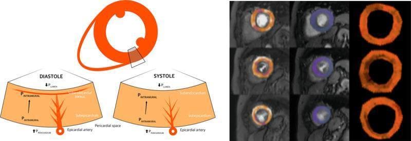 This composite educational graphic details the pathophysiology of myocardial perfusion and coronary hemodynamics. Panel A features a pathophysiology diagram illustrating the extravascular forces and intraluminal pressures affecting the myocardial layers during the cardiac cycle. It compares diastole and systole, highlighting the differences in intramural pressure (PINTRAMURAL), left ventricular lumen pressure (PLUMEN), and pericardial space pressure (PPERICARDIUM). The diagram shows the subendocardial plexus and epicardial artery, emphasizing greater subendocardial compression and reduced vascular volume during systole. Panel B presents a cardiac perfusion quantification map from a patient with aortic stenosis (AS). The map is organized in a grid: rows represent basal, mid, and apical short-axis slices of the left ventricle; columns demonstrate stress perfusion, rest perfusion, and myocardial perfusion reserve (MPR). The color-coded mapping shows regional perfusion distribution, with the MPR column specifically highlighting global limitations in perfusion reserve. This visual is designed for medical education focusing on cardiovascular hemodynamics, coronary microcirculation, and the physiological impact of valvular heart disease on myocardial blood flow.